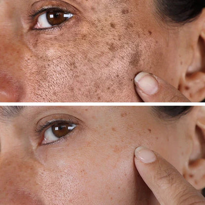 (🔥Last Day Promotion 70% OFF)Fast Dark Spot Remover-BeamBalm™ Melanin Correcting Facial Serum