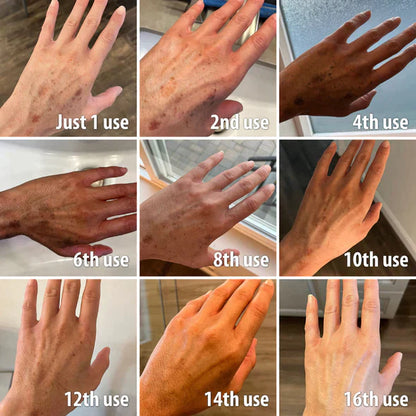 (🔥Last Day Promotion 70% OFF)Fast Dark Spot Remover-BeamBalm™ Melanin Correcting Facial Serum